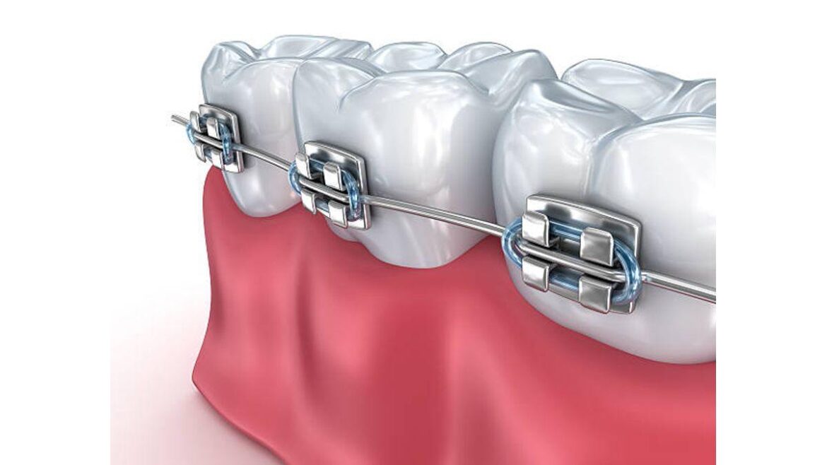 Smile Designing in Dentistry